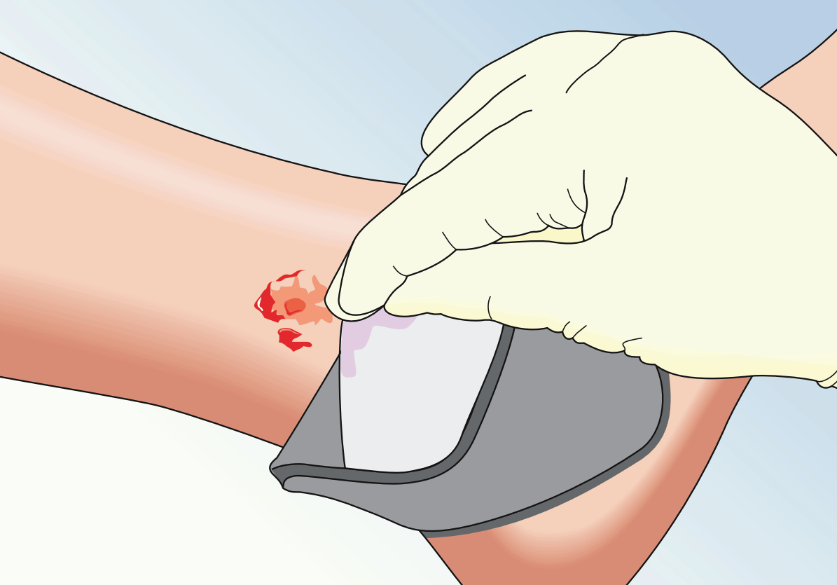 Mepilex Ag Antimicrobial Foam Dressing