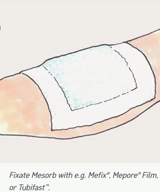 Mesorb Superabsorbent Dressing