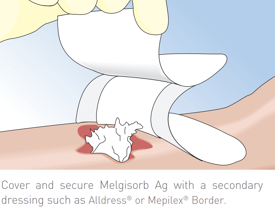 Melgisorb Ag Antimicrobial Alginate Dressing