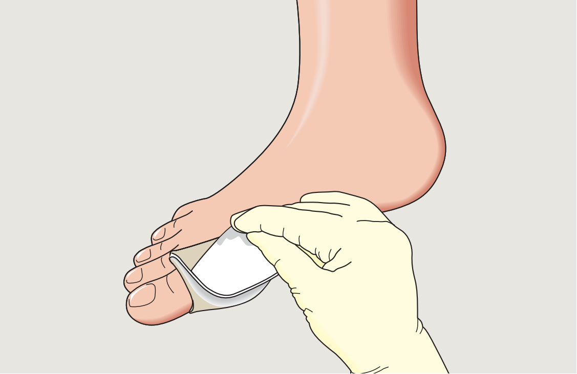 Mepilex Lite Foam Dressing