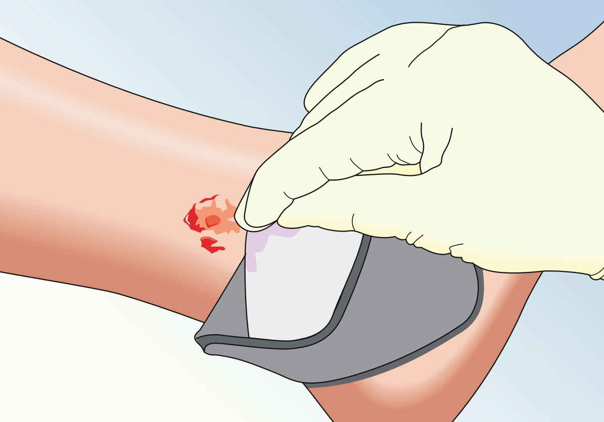 Mepilex Ag Antimicrobial Foam Dressing