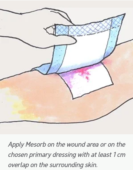 Mesorb Superabsorbent Dressing