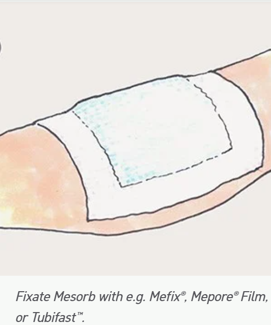 Mesorb Superabsorbent Dressing