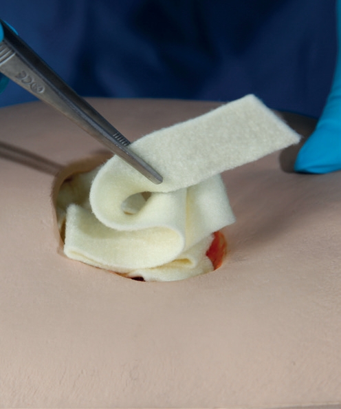 Exufiber Gelling Fiber Dressing